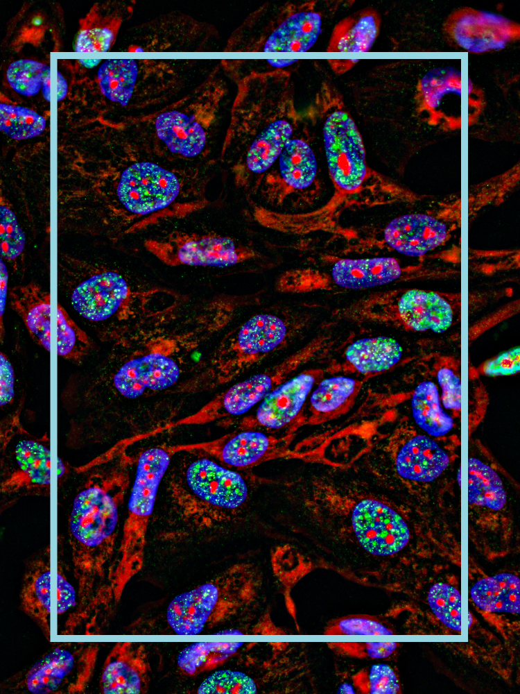 Colourful picture of cancer cells
