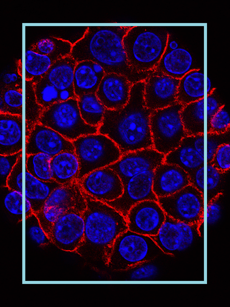 Pancreatic cancer cells