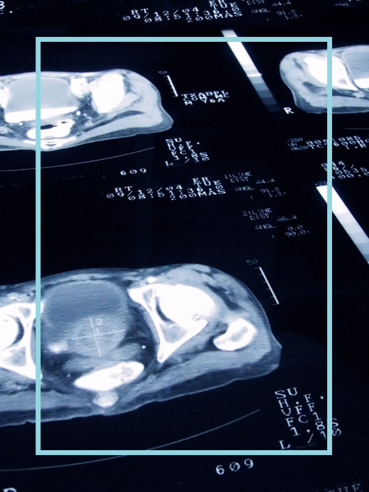 A prostate cancer scan image