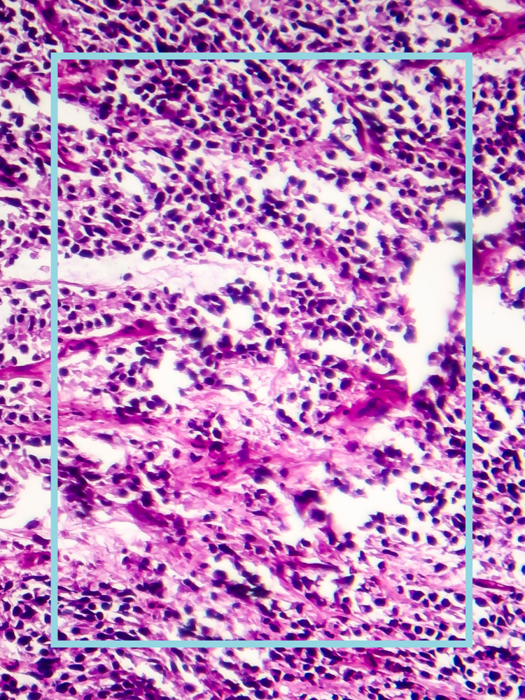 Cancer cells