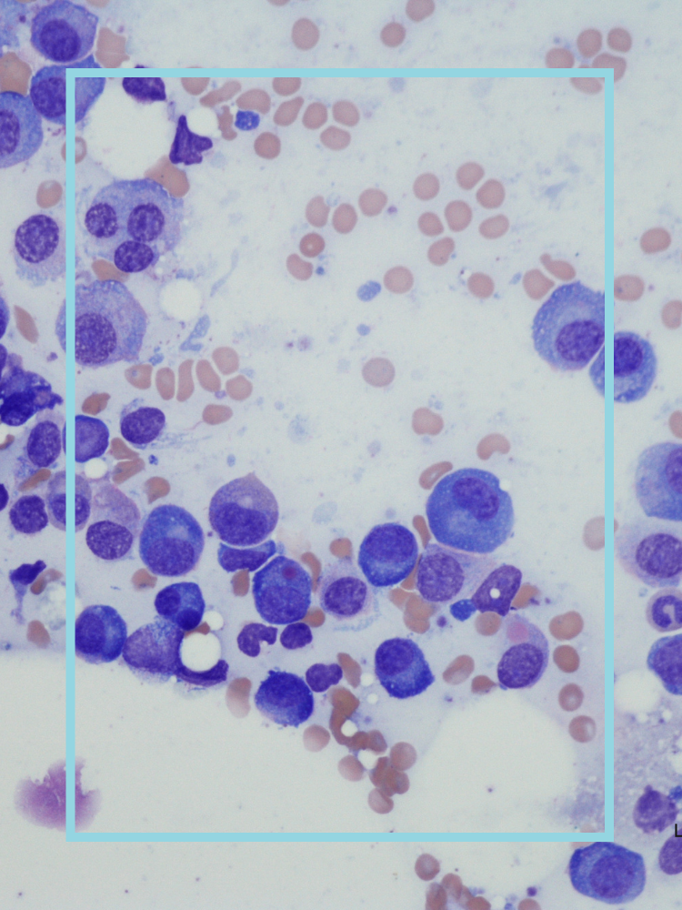Myeloma cells
