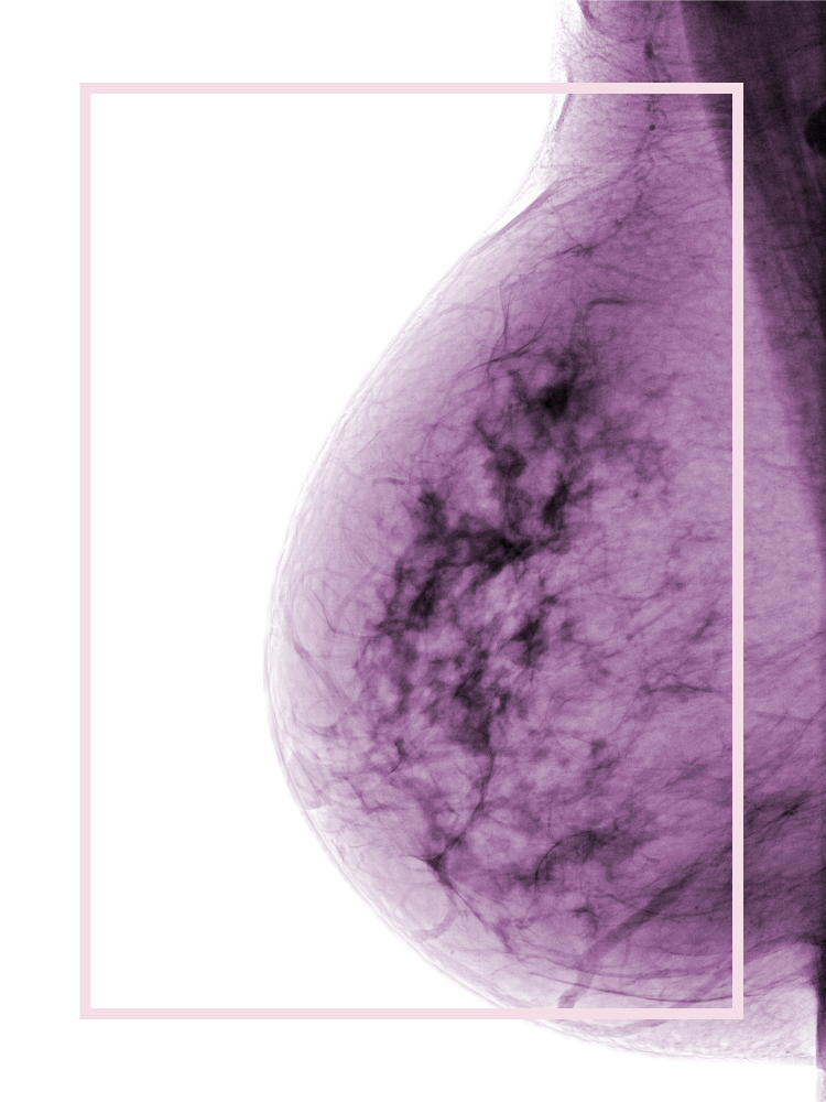 mammogram image