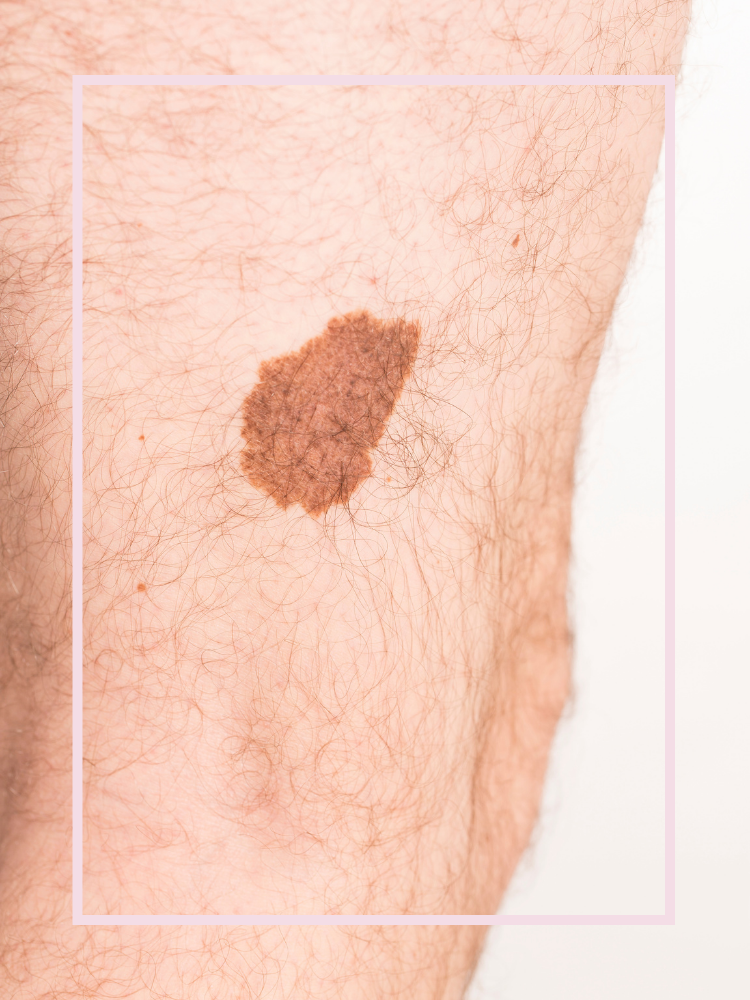 Melanoma on white skin
