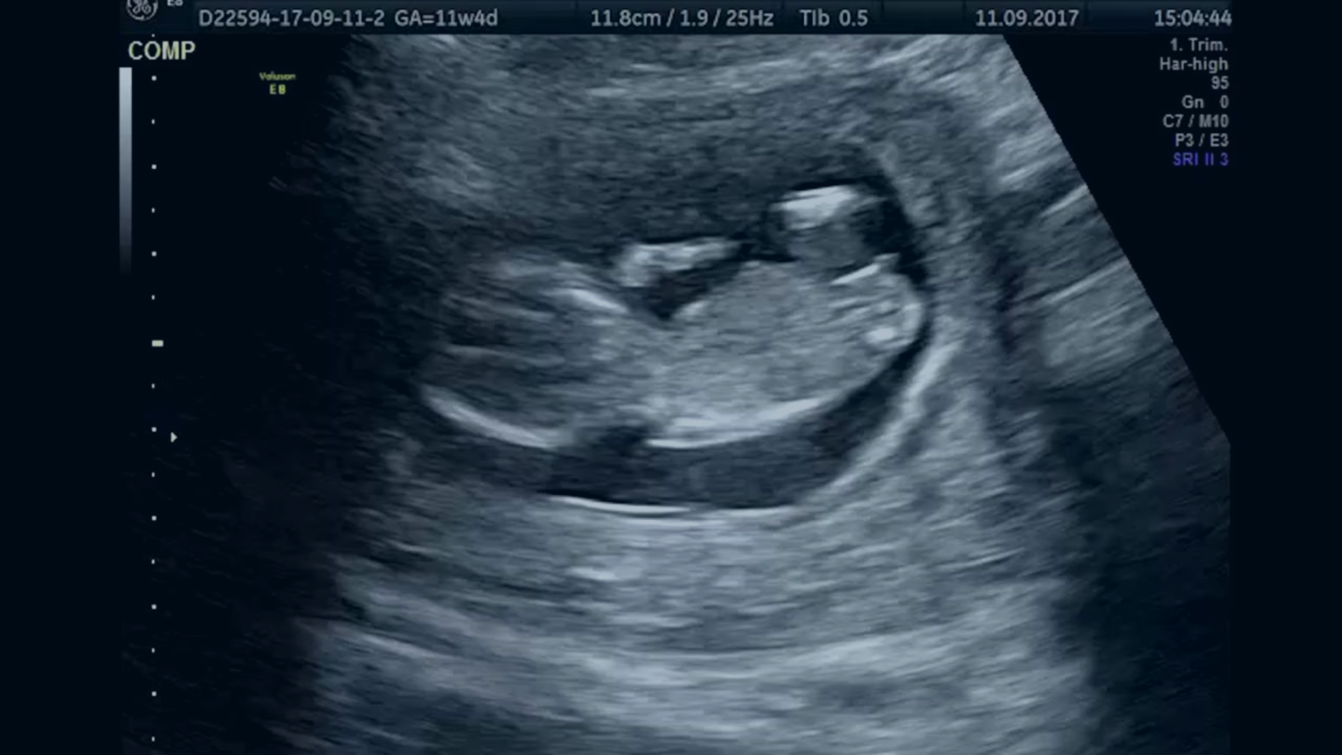 A black and white image of an ultrasound scan