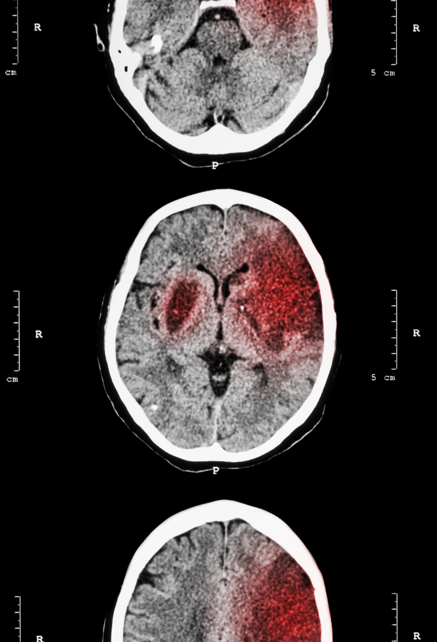 An MRI scan showing activity of a stroke