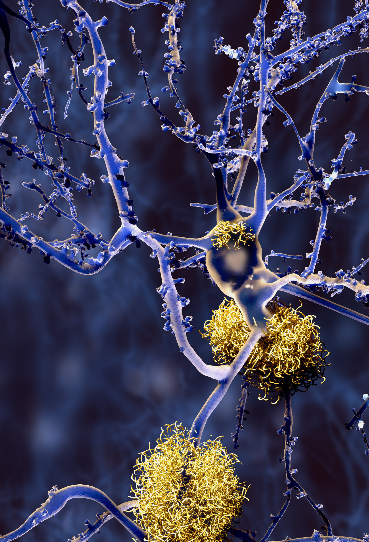 Alzheimer's disease, neurons with amyloid plaques